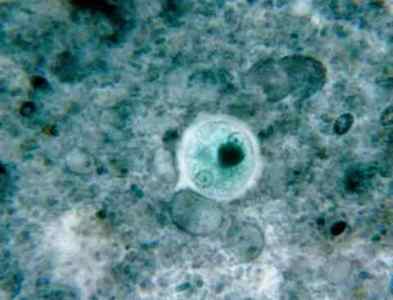 Дизентерійна амеба: що це, життєвий цикл паразита, і які захворювання він викликає?
