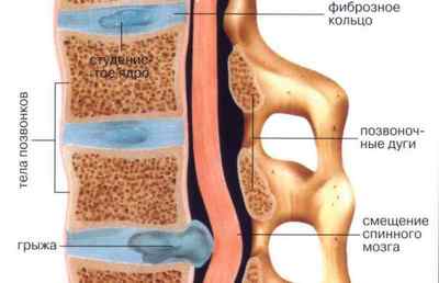 Дорзальная дифузна грижа: що це таке, лікування протрузії міжхребцевого диска | Ревматолог