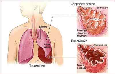 Довго не проходить кашель після застуди: причини, лікування