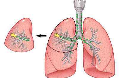 Дрібноклітинний рак легенів: стадії, прогнози, методи лікування