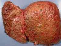 Дрібновузлового цироз печінки: що це таке, Мікронодулярний патологія
