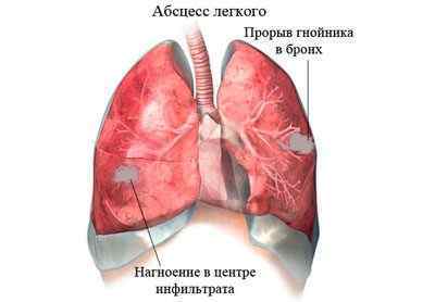 Двостороння пневмонія (запалення легенів): симптоми, лікування, наслідки