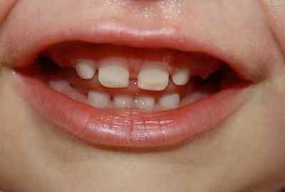 Дізнаємося схему (порядок) прорізування молочних зубів у дітей