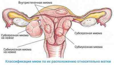 ЕКО при міомі матки: чи можливо завагітніти