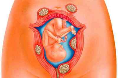 ЕКО при міомі матки: чи можливо завагітніти