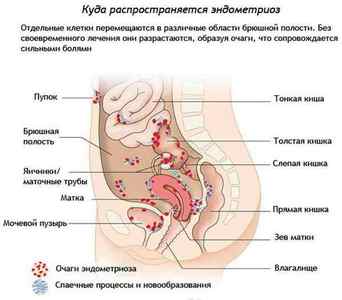 Екстрагенітальний ендометріоз: симптоми, лікування