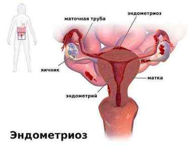 Екстрагенітальний ендометріоз: симптоми, лікування