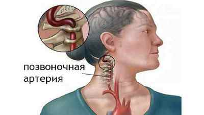Екстравазальна компресія хребетної артерії що це таке, ознаки та лікування | Ревматолог