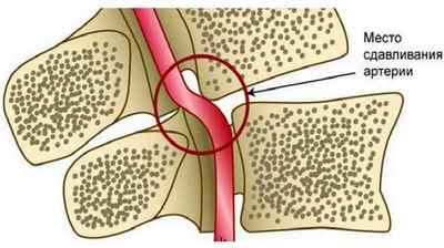 Екстравазальна компресія хребетної артерії що це таке, ознаки та лікування | Ревматолог
