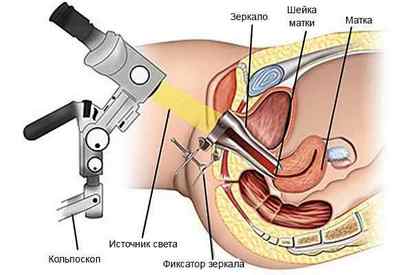Ектропіон шийки матки: причини, лікування, симптоми