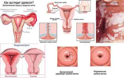 Ектропіон шийки матки: причини, лікування, симптоми