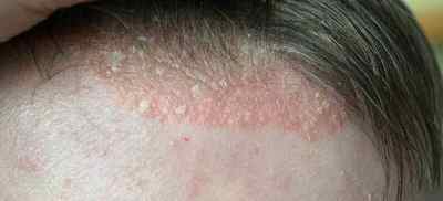 Екзема на голові (на волосистій частині): лікування