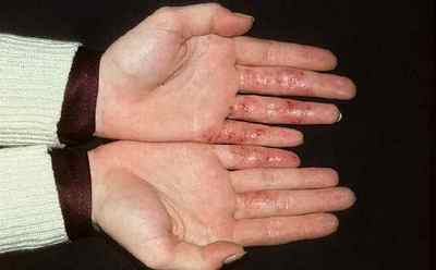Екзема на пальцях рук: лікування (як позбутися)