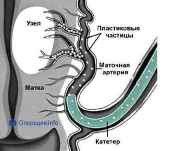 Емболізація маткових артерій (ЕМА) при міомі матки