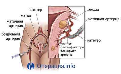 Емболізація маткових артерій (ЕМА) при міомі матки