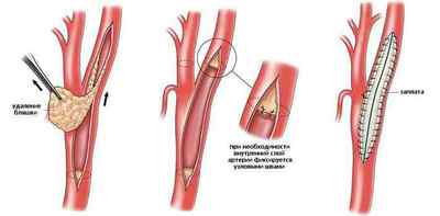 Ендартеректомія, операція видалення бляшок: каротидна (сонних артерій), нижніх кінцівок