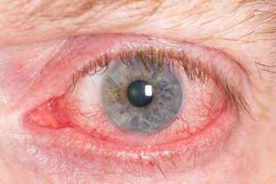 Ендокринна офтальмопатія: симптоми і лікування