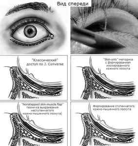 Ендокринна офтальмопатія: симптоми і лікування