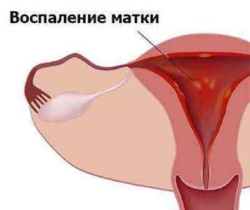 Ендометріоїдна кіста шийки матки: симптоми і лікування