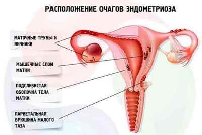 Ендометріоїдна кіста шийки матки: симптоми і лікування