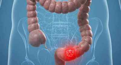 Ендометріоз кишечника: симптоми і лікування