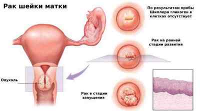 Ендометріоз після кесаревого розтину і післяопераційного рубця