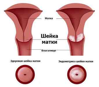 Ендометріоз шийки матки: причини, симптоми, лікування