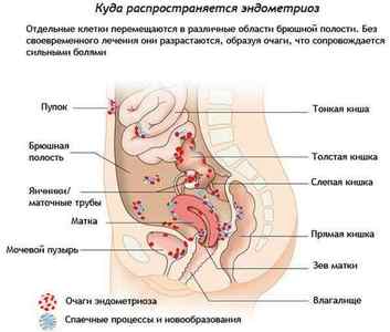 Ендометріоз: симптоми і лікування