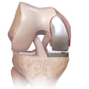 Ендопротезування колінного суглоба і реабілітація після