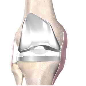 Ендопротезування колінного суглоба і реабілітація після