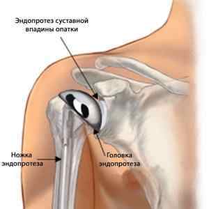 Ендопротезування плечового суглоба: вправи після заміни суглоба, вартість операції, інвалідність і реабілітація | Ревматолог