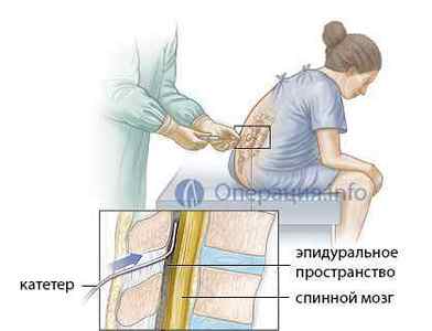 Епідуральна анестезія: застосування, як проводиться, наслідки