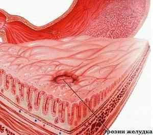 Ерозія антрального відділу шлунка: причини розвитку, види, симптоми, лікування