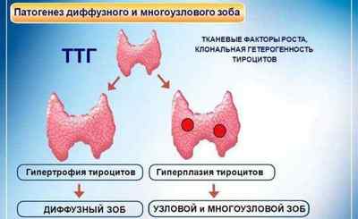 Еутиреоїдний зоб щитовидної залози 1 і 2 ступеня: що це таке