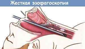 Езофагоскопія: що це таке, підготовка, як роблять, відгуки, ціна в Москві