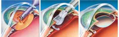 Факоемульсифікація катаракти з імплантацією ІОЛ: хід і види операції, реабілітація