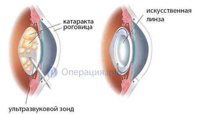 Факоемульсифікація катаракти з імплантацією ІОЛ: хід і види операції, реабілітація