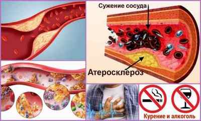 Фактори ризику атеросклерозу: алкоголь, куріння, цукровий діабет, ожиріння
