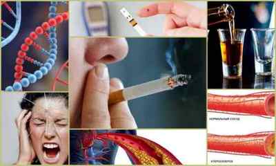 Фактори ризику атеросклерозу: алкоголь, куріння, цукровий діабет, ожиріння