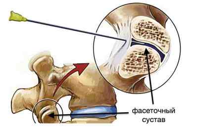 Фасеточний синдром: що це таке і лікування артрозу фасеткових суглобів хребта | Ревматолог