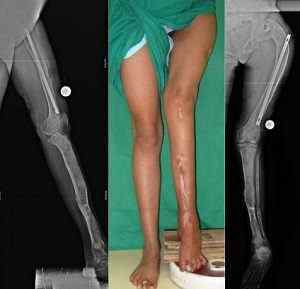 Фіброзна дисплазія стегнової кістки, великої гомілкової кістки, колінного суглоба і щелепи: лікування | Ревматолог