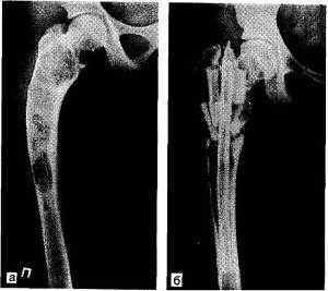 Фіброзна дисплазія стегнової кістки, великої гомілкової кістки, колінного суглоба і щелепи: лікування | Ревматолог