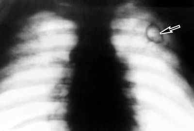 Фіброзно-кавернозний туберкульоз легень: симптоми, лікування