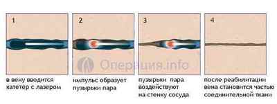 Флебектомія (венектомія): операція і її види, хід, результат