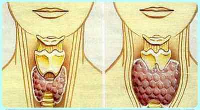 Фолікулярна пухлина щитовидної залози: що це таке, операція і лікування