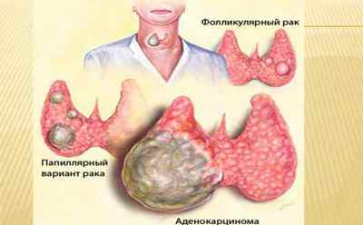 Фолікулярна пухлина щитовидної залози: що це таке, операція і лікування