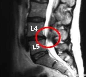 Форамінальні грижа міжхребцевого диска l4 l5 l5 s1: парафорамінальная грижа, Парамедіанна-форамінальні і екстрафорамінальная грижі | Ревматолог
