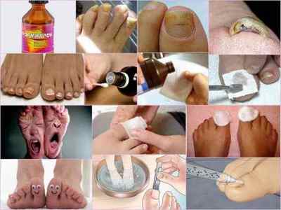 Формідрон від грибка нігтів на ногах: інструкція із застосування, ціна, відгуки