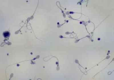 Фрагментація ДНК спермограми (сперматозоїдів): аналіз та лікування