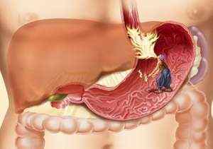 Функціональний розлад шлунка: код по МКБ 10 симптоми, що робити